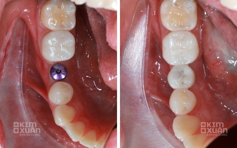 Trồng Răng Implant Ngăn Ngừa Tiêu Xương Hàm