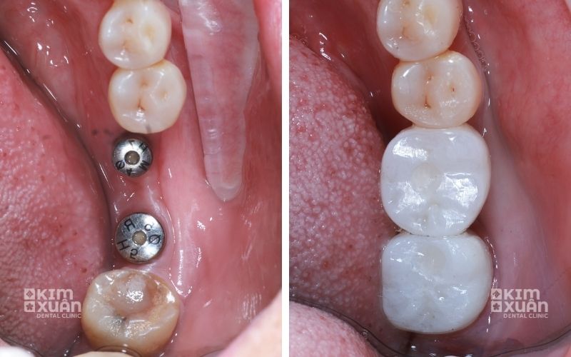 Trồng Răng Implant Ngăn Ngừa Tiêu Xương Hàm
