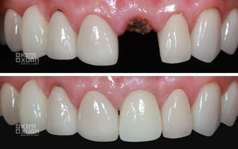 Cấy Ghép Implant Răng Cửa Trước Và Sau