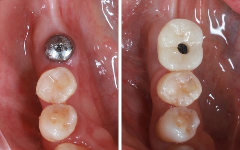 Trồng Răng Implant Răng Số 6