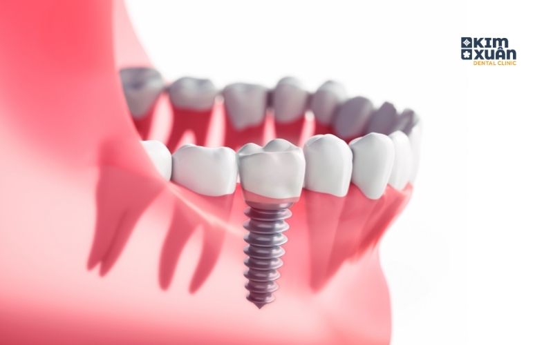 Trồng Răng Implant Răng Số 6 Uy Tín Tại TP. HCM