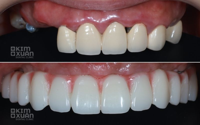 Trồng Răng Implant Sau Khi Bị Tiêu Xương Hàm
