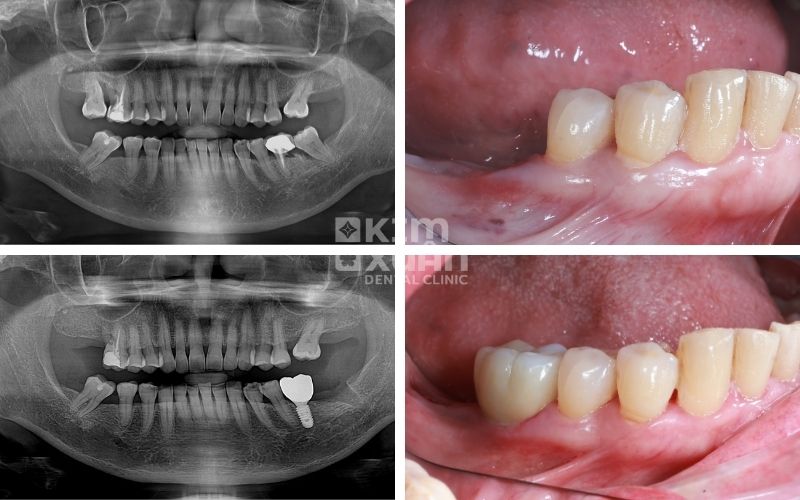 Trồng Răng Implant Sau Khi Nhổ Răng Cấm