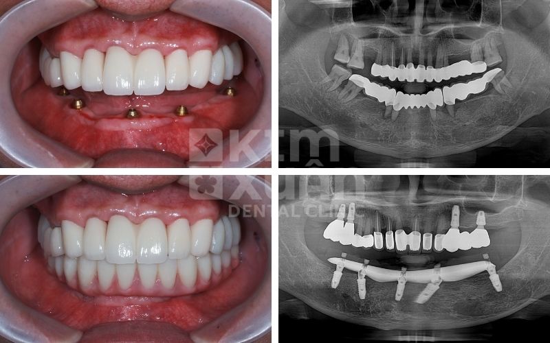 Trồng Răng Implant Sau Khi Nhổ Răng