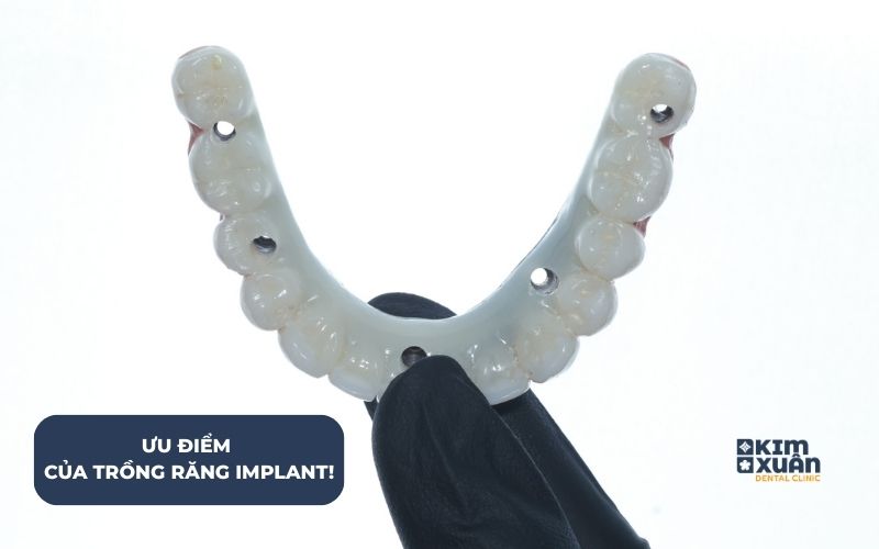 Trồng Răng Implant Tại Nha Khoa Kim Xuân