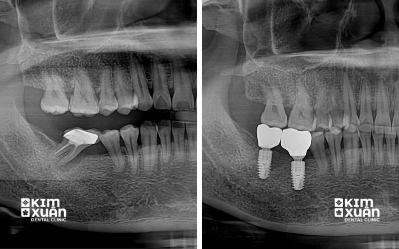 Trồng Răng Implant Nha Khoa Kim Xuân