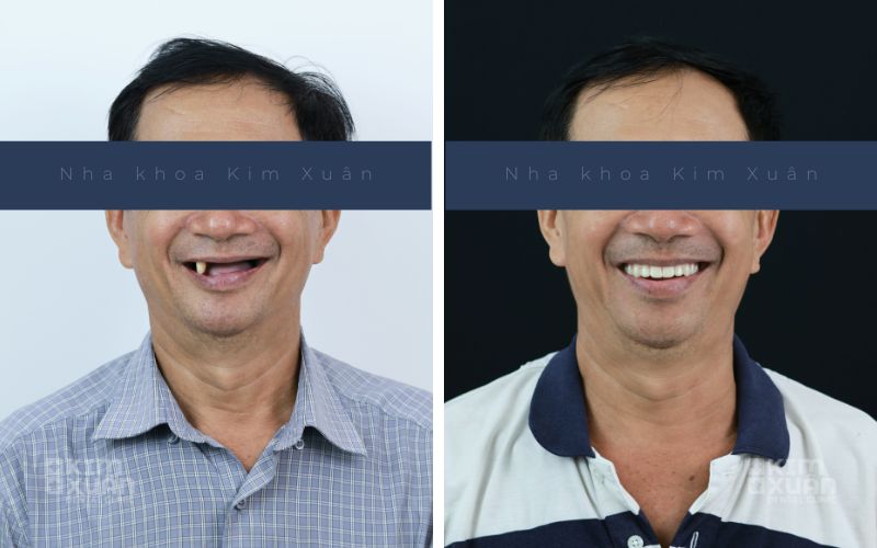 Trồng Răng Implant Tại Nha Khoa Kim Xuân