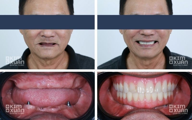 Trồng Răng Implant Toàn Hàm Cho Người Già Mất Răng