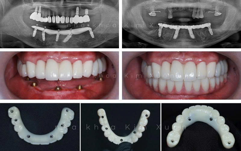 Trồng Răng Implant Toàn Hàm Giá Bao Nhiêu