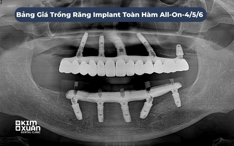 Trồng Răng Implant Toàn Hàm Giá Bao Nhiêu