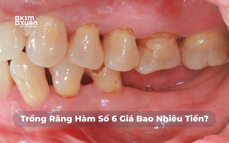 trồng răng số 6 giá bao nhiêu tiền