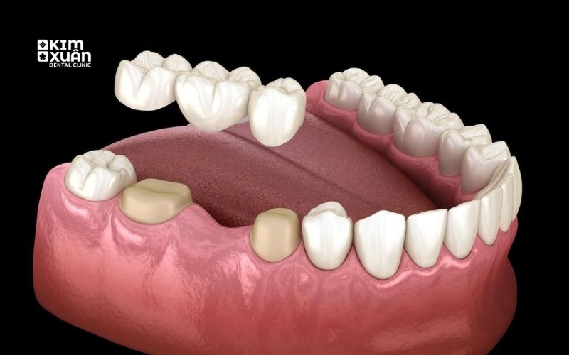 Trồng Răng Sứ Vĩnh Viễn Cầu Răng Sứ