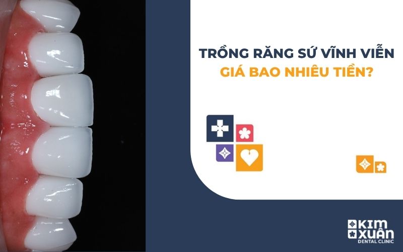 Trồng Răng Sứ Vĩnh Viễn Giá Bao Nhiêu