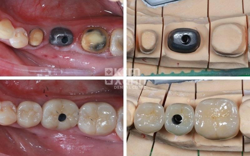 Trồng Răng Sứ Vĩnh Viễn Trên Implant