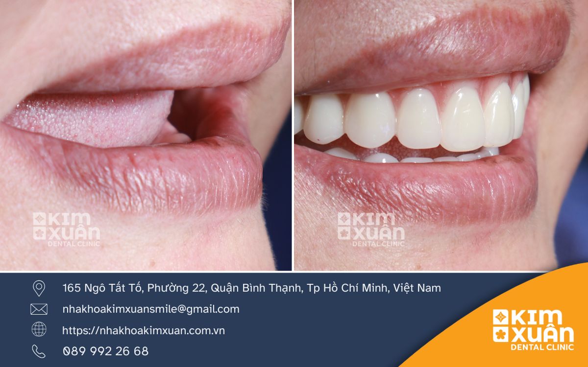 Trồng Răng Tháo Lắp