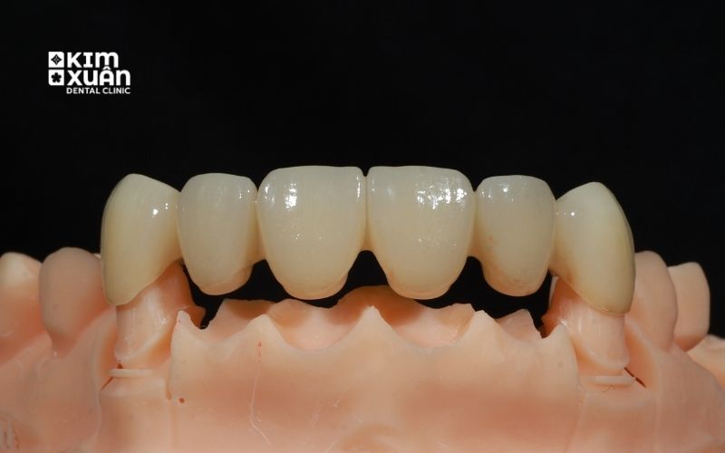 Trồng Răng Vĩnh Viễn Cầu Răng Sứ