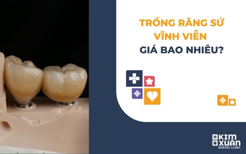 Trồng Răng Vĩnh Viễn Giá Bao Nhiêu
