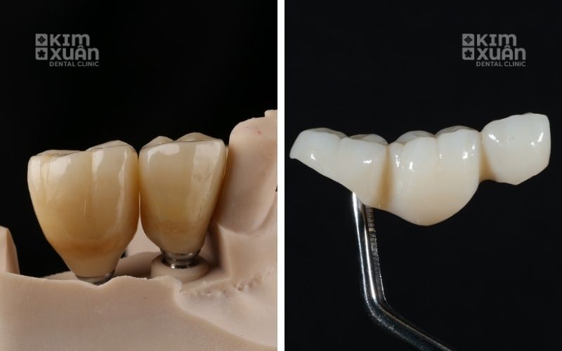 Trồng Răng Vĩnh Viễn Trên Implant