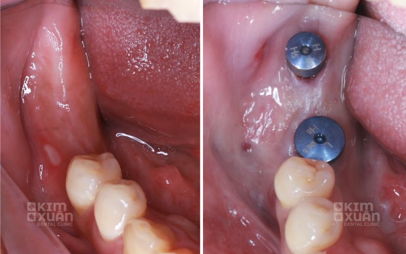 Trụ Implant Mis C1 Giá Bao Nhiêu