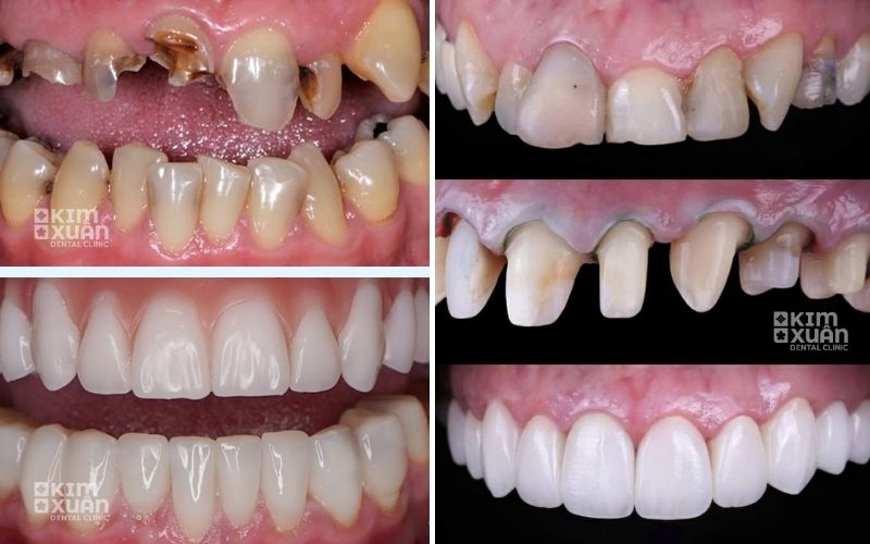 Hình ảnh trước và sau khi bọc răng sứ thẩm mỹ, cải thiện răng hư hỏng và nụ cười hài hòa tại Nha khoa Kim Xuân