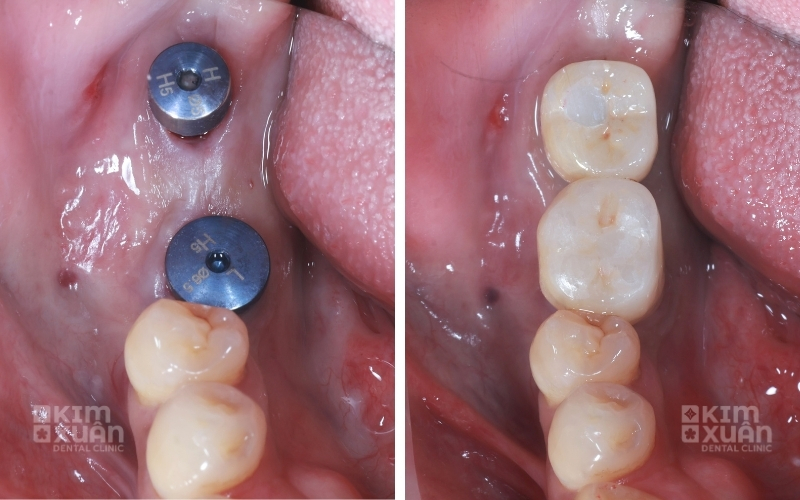 Ảnh Trước Và Sau Khi Trồng Răng Implant Tại Nha Khoa Kim Xuân