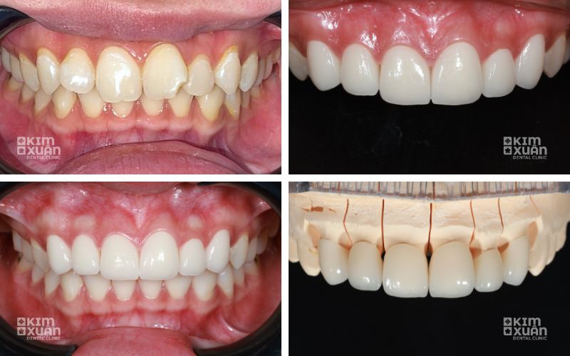 Hình ảnh trước và sau dán sứ Veneer cải thiện hình dáng và màu sắc răng cửa
