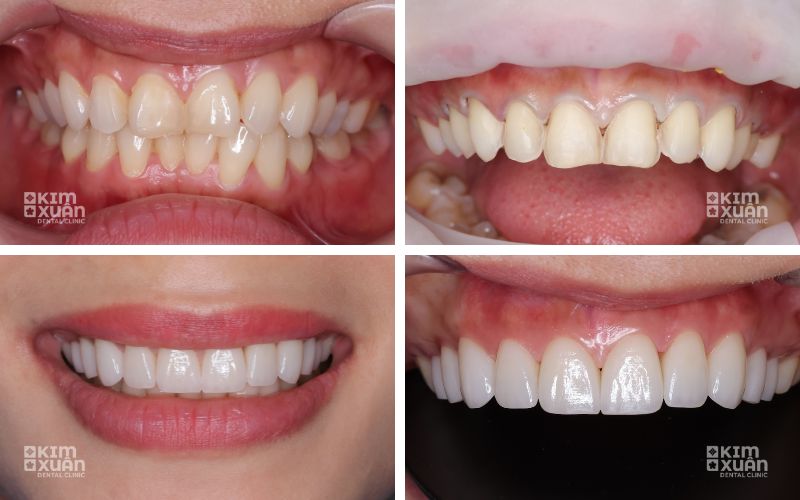 Hình ảnh trước và sau dán sứ Veneer cải thiện màu sắc và hình dáng răng cửa