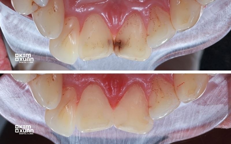 Hình ảnh trước sau điều trị sâu răng kẽ răng trước
