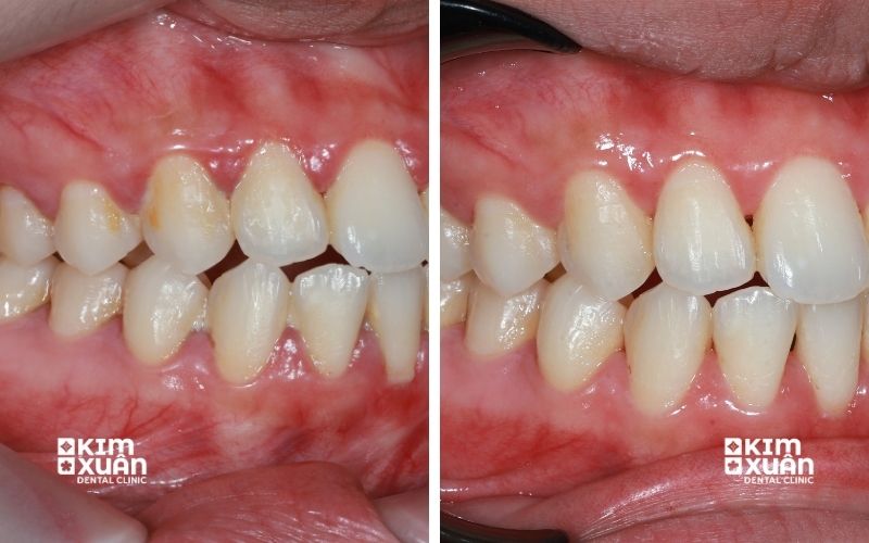 Hình ảnh trước và sau khi lấy cao răng giúp răng sạch hơn nướu hồng hào khỏe mạnh