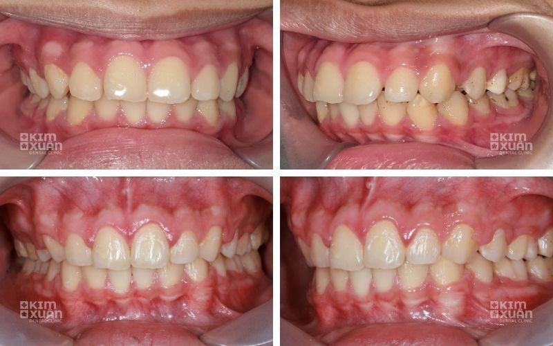 Trước Và Sau Khi Niềng Răng ở Tuổi 40