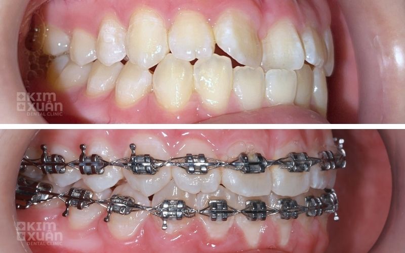 Trước Và Sau Khi Niềng Răng Tại Nha Khoa Kim Xuân