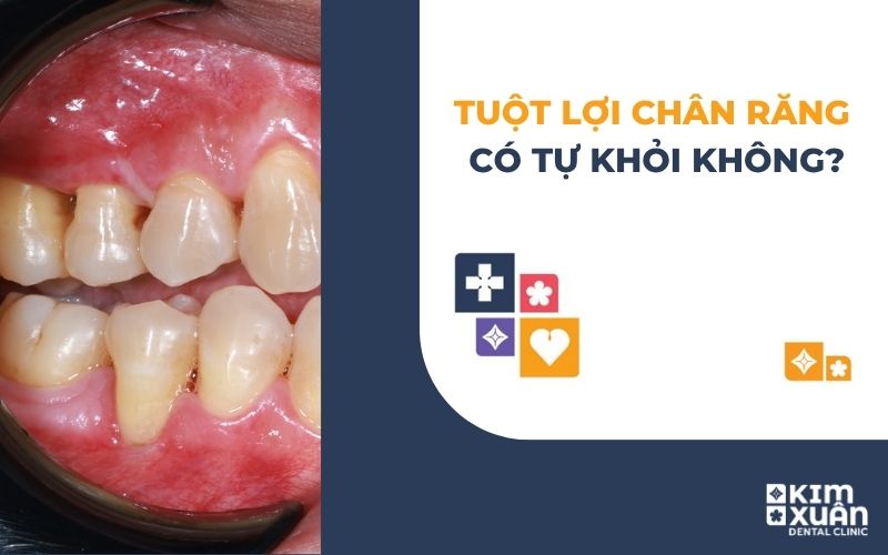 Tụt Lợi Chân Răng Có Tự Khỏi Không