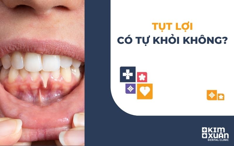 Tụt Lợi Chân răng Có Tự Khỏi Không