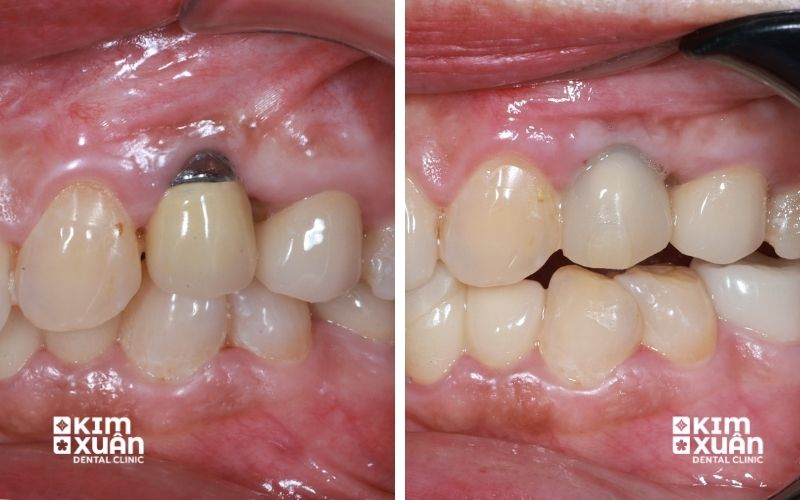 Tụt Lợi Có Tự Khỏi Không