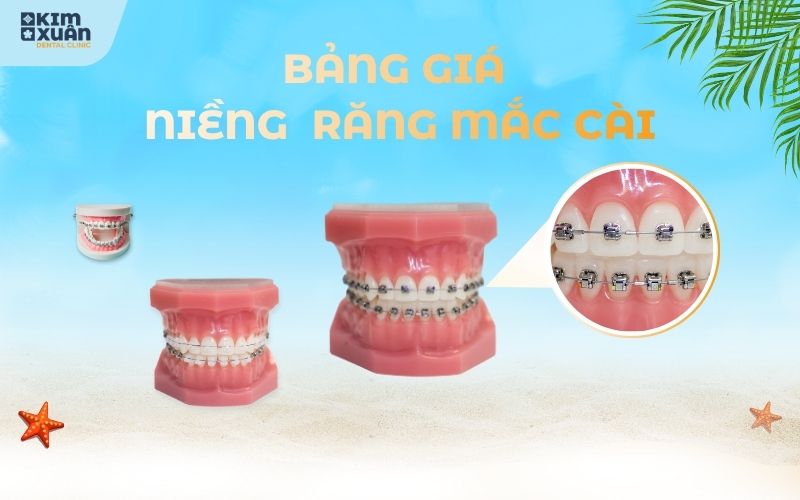 Ưu Đãi Niềng Răng Mùa Hè Tại Nha Khoa Kim Xuân