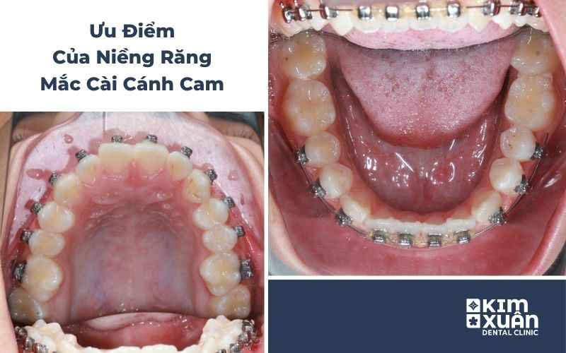 Ưu điểm của mắc cài cánh cam