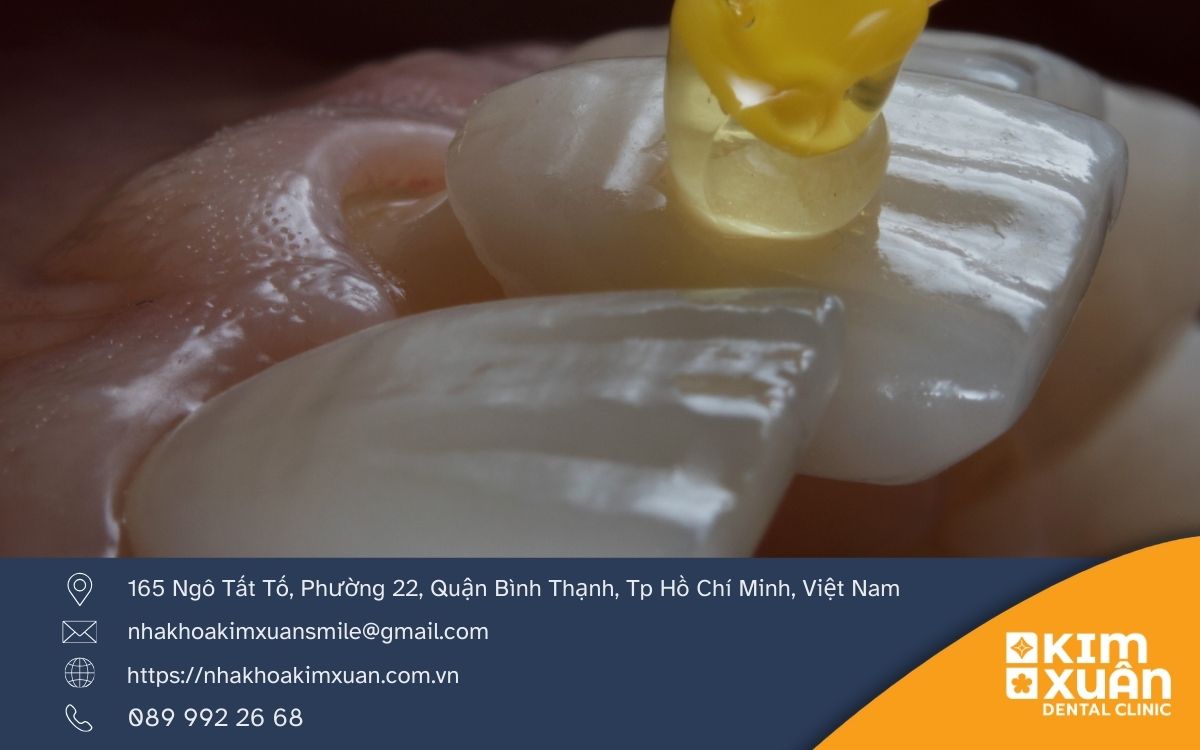 Ưu Điểm Của Mặt Dán Răng Sứ Veneer