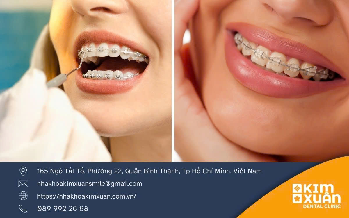 Ưu Điểm Của Niềng Răng Mắc Cài Sứ
