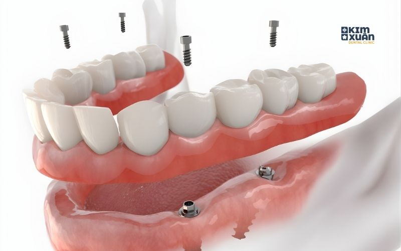 Ưu Điểm Của Trồng Răng Implant All On 4