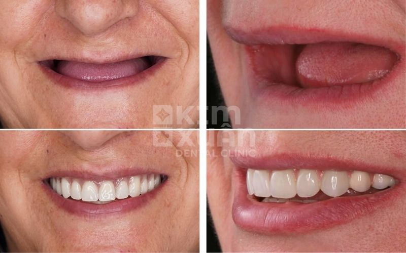 Ưu Điểm Của Trồng Răng Tháo Lắp