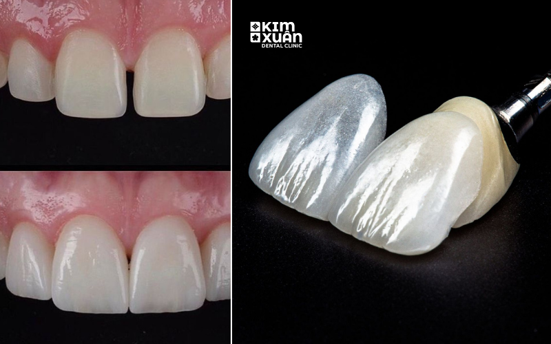 Ưu Điểm Dán Răng Sứ Veneer