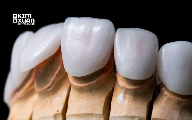 Ưu Điểm Dán Răng Sứ Veneer Nguyên Hàm