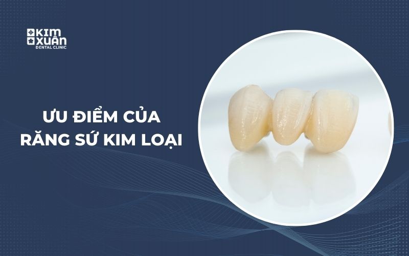 Ưu Điểm Khi Bọc Răng Sứ Kim Loại