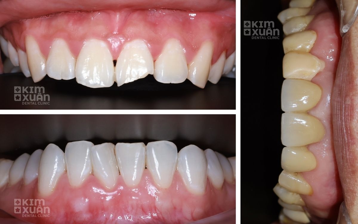 Ưu Điểm Mặt Dán Sứ Veneer Emax