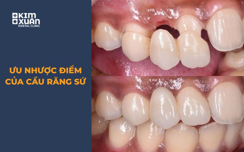 Ưu Điểm Nhược Điểm Của Cầu Răng Sứ