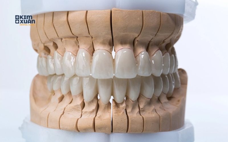 Ưu Điểm Nhược Điểm Của Răng Sứ Zirconia