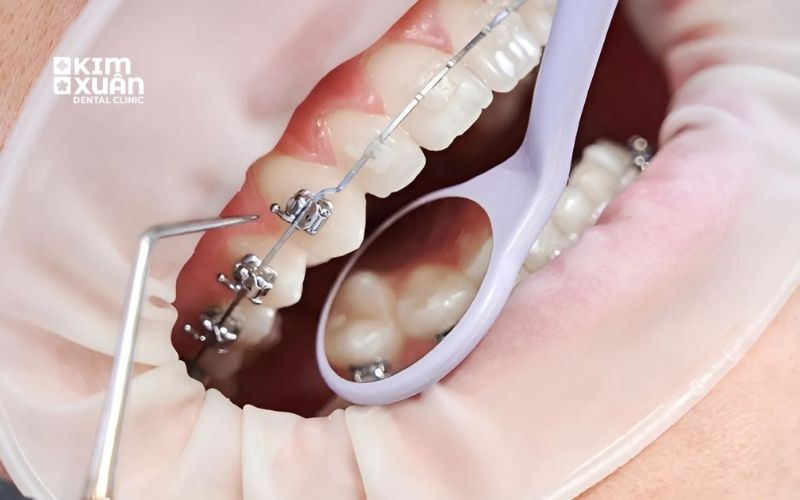Ưu Điểm Niềng Răng Mắc Cài Kim Loại