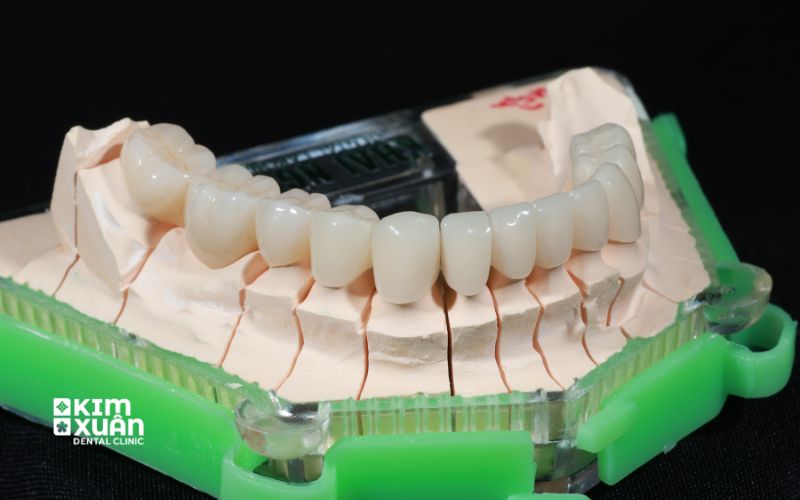 Ưu Nhược Điểm Của Cầu Răng Sứ