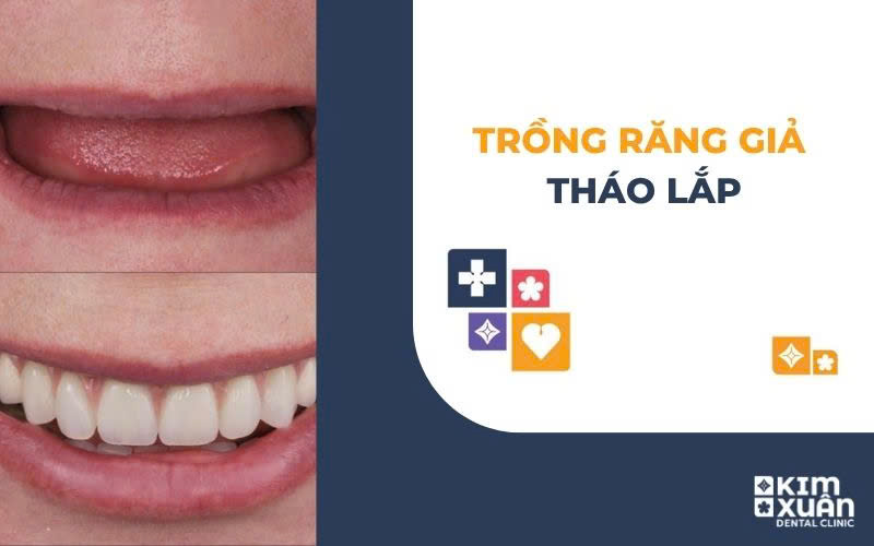 Ưu Nhược Điểm Của Răng Tháo Lắp
