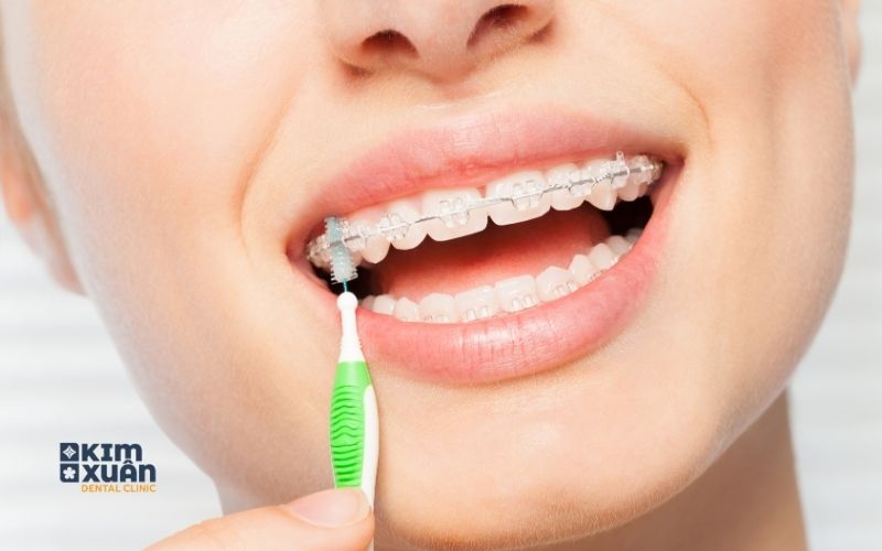 Niềng Răng Mắc Cài Sứ Ưu Nhược Điểm